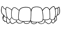 Deep Bite / Overbite